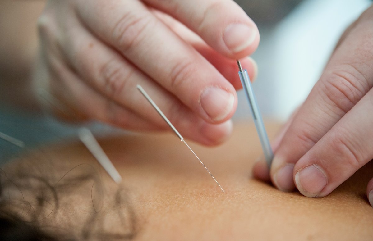 Dry needling treatment — close-up of acupuncture needles being inserted